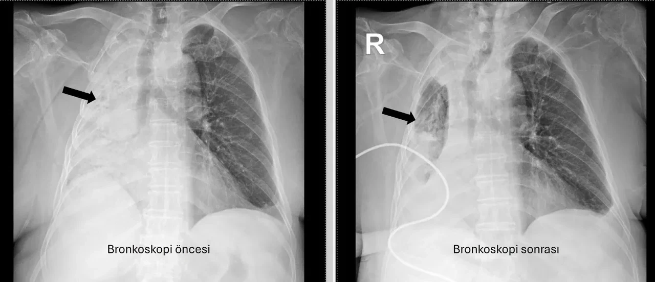 Akıllara durgunluk veren olay: Nefes borusuna kaçtı, aylar sonra ortaya çıktı