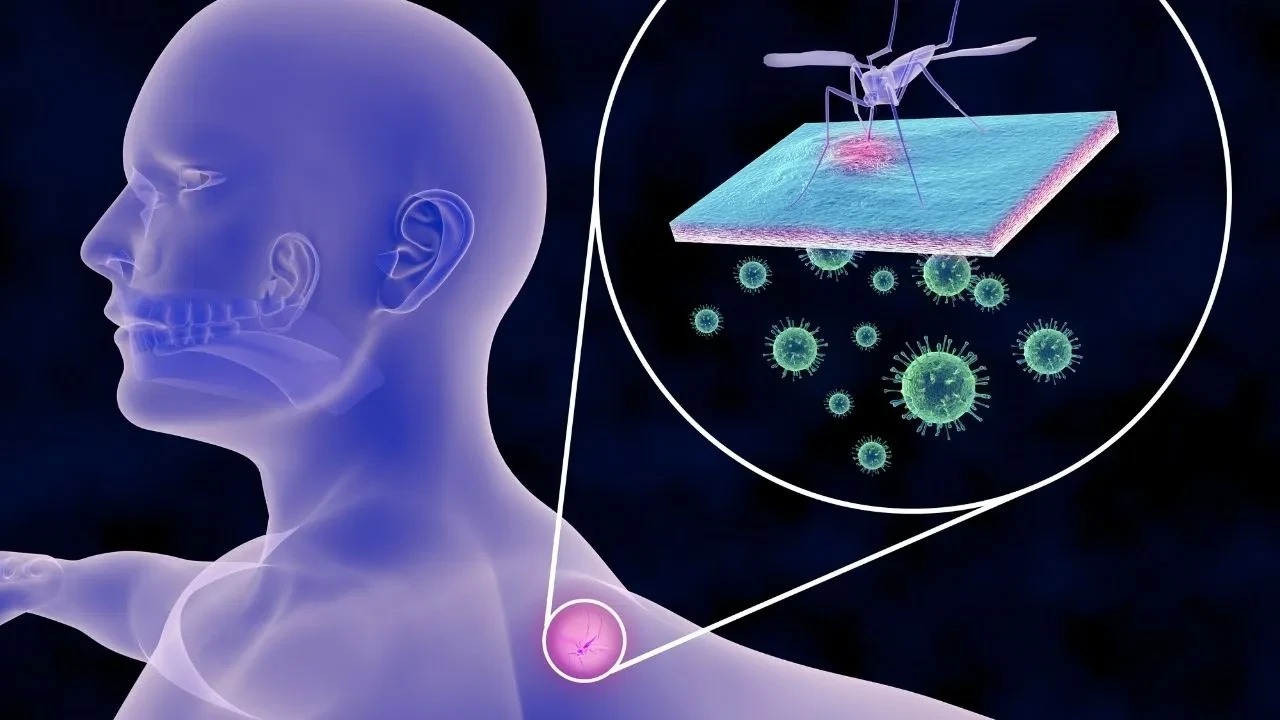 Chikungunya virüsü nedir, belirtileri neler? DSÖ'den uyarı: Sivrisineklere dikkat