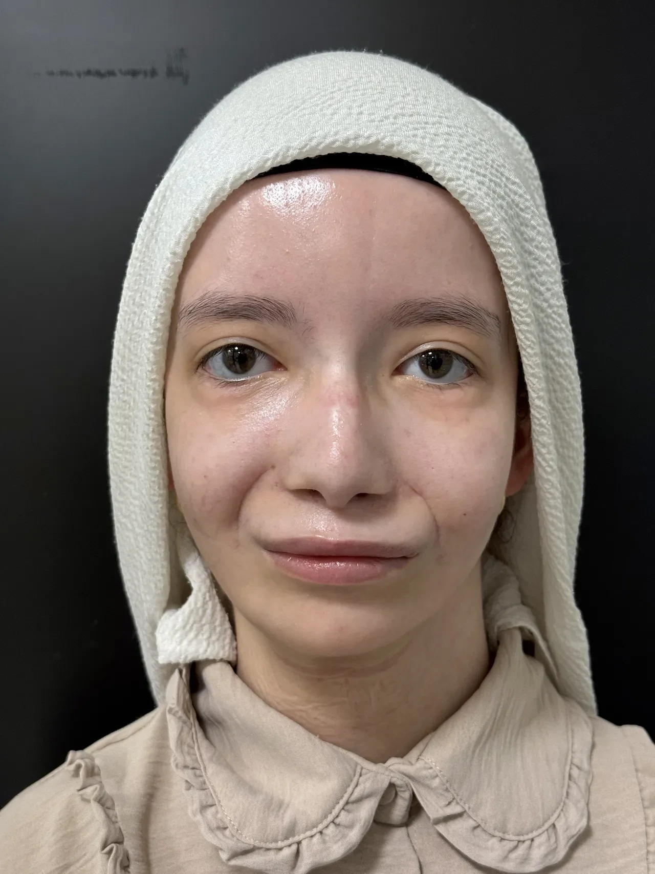 Türkiye’de bir ilk: 23 yıl sonra ilk kez gülümsedi! 'Sürekli aynaya bakıyorum'