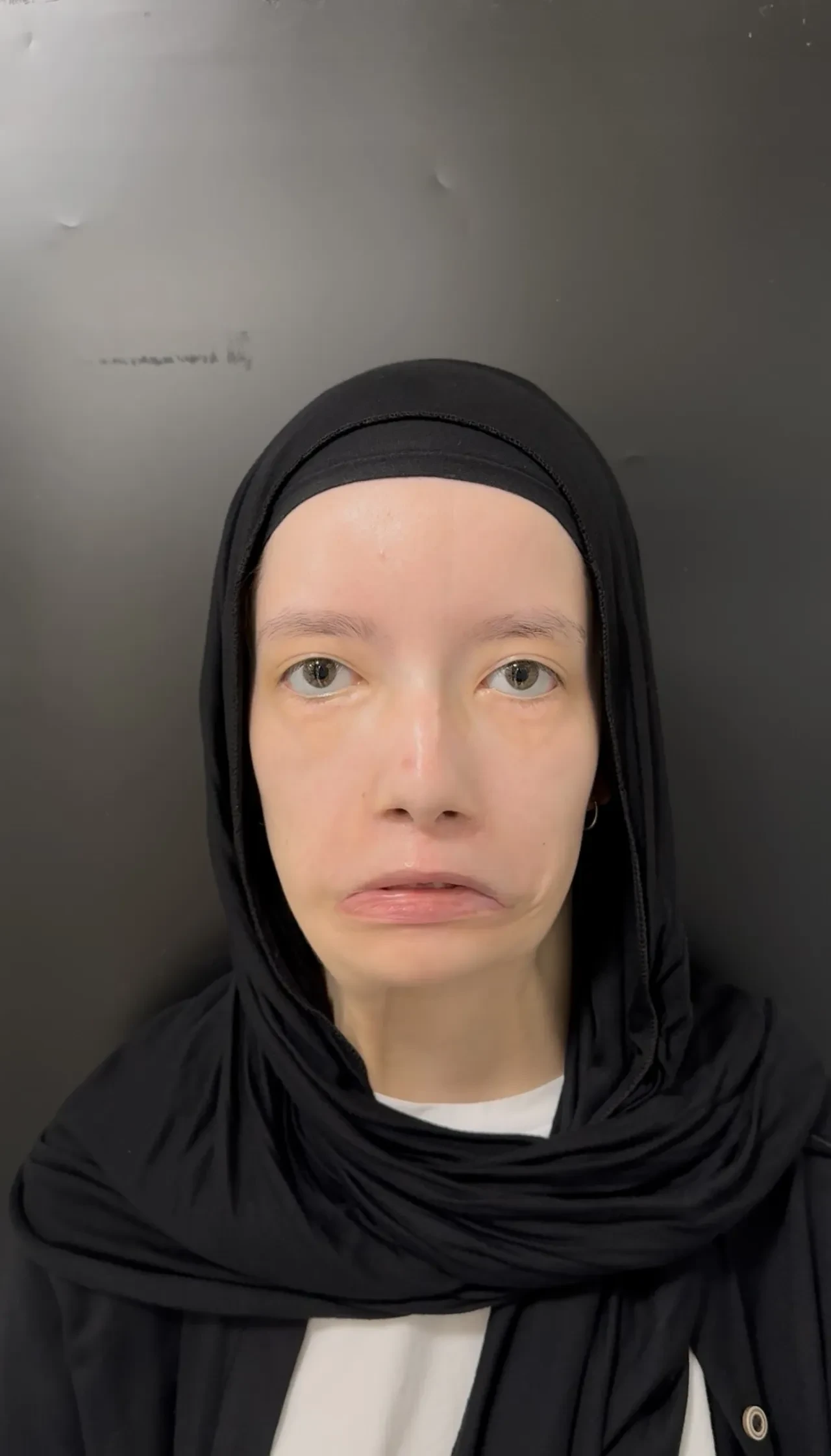 Türkiye’de bir ilk: 23 yıl sonra ilk kez gülümsedi! 'Sürekli aynaya bakıyorum'