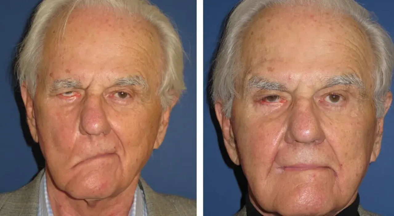 Yüz felci neden olur sebepleri neler? Sessizce gelen tehlike