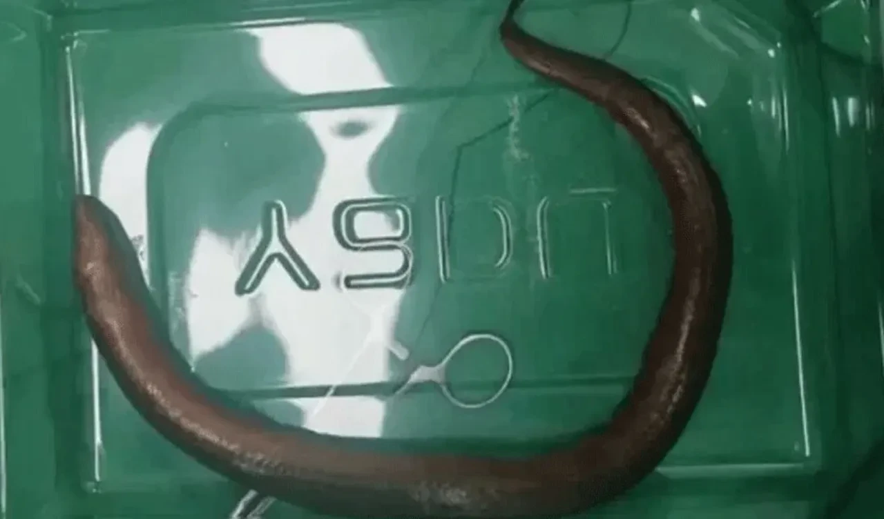 Şiddetli mide ağrısıyla hastaneye başvurdu, içinden canlı yılan balığı çıktı