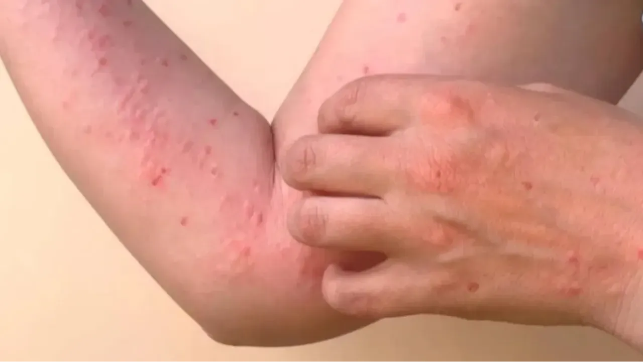 Hızla yayılan chikungunya virüsü yeni büyük tehdit!