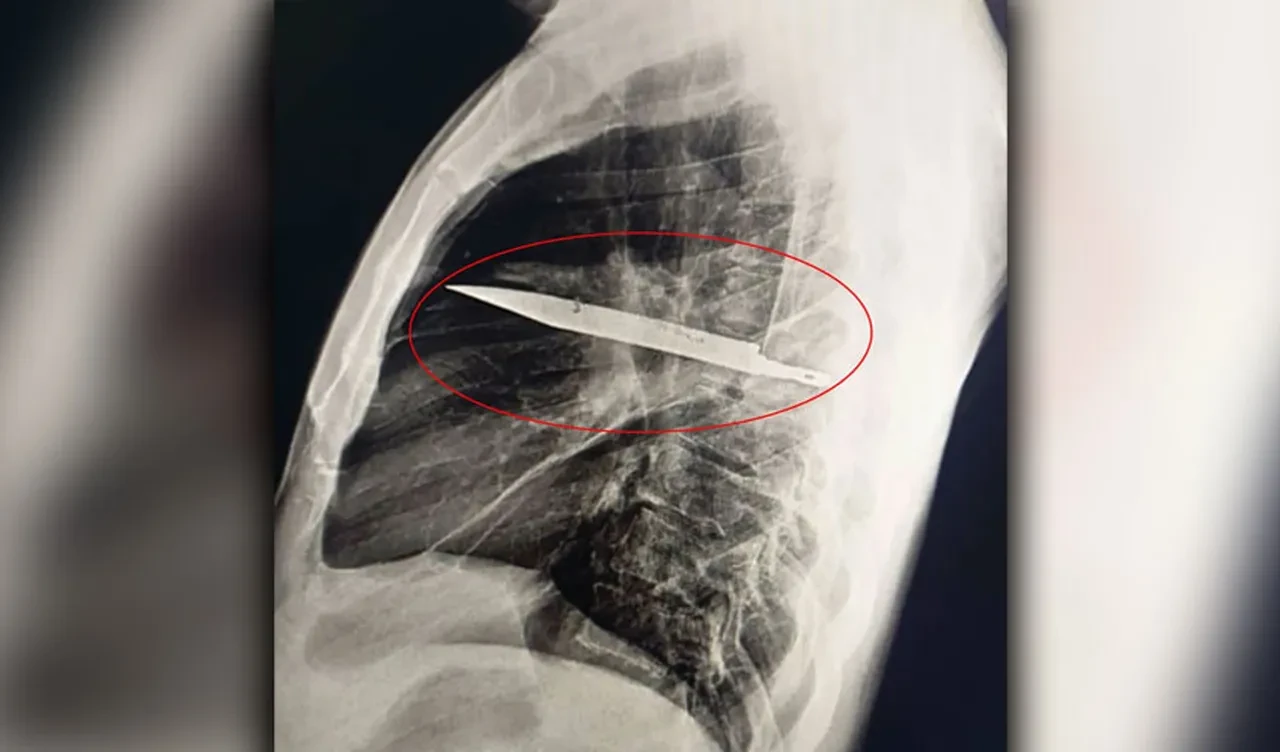 Göğsünde bıçakla 8 sene yaşadı! Seneler önce ettiği kavga aklına geldi