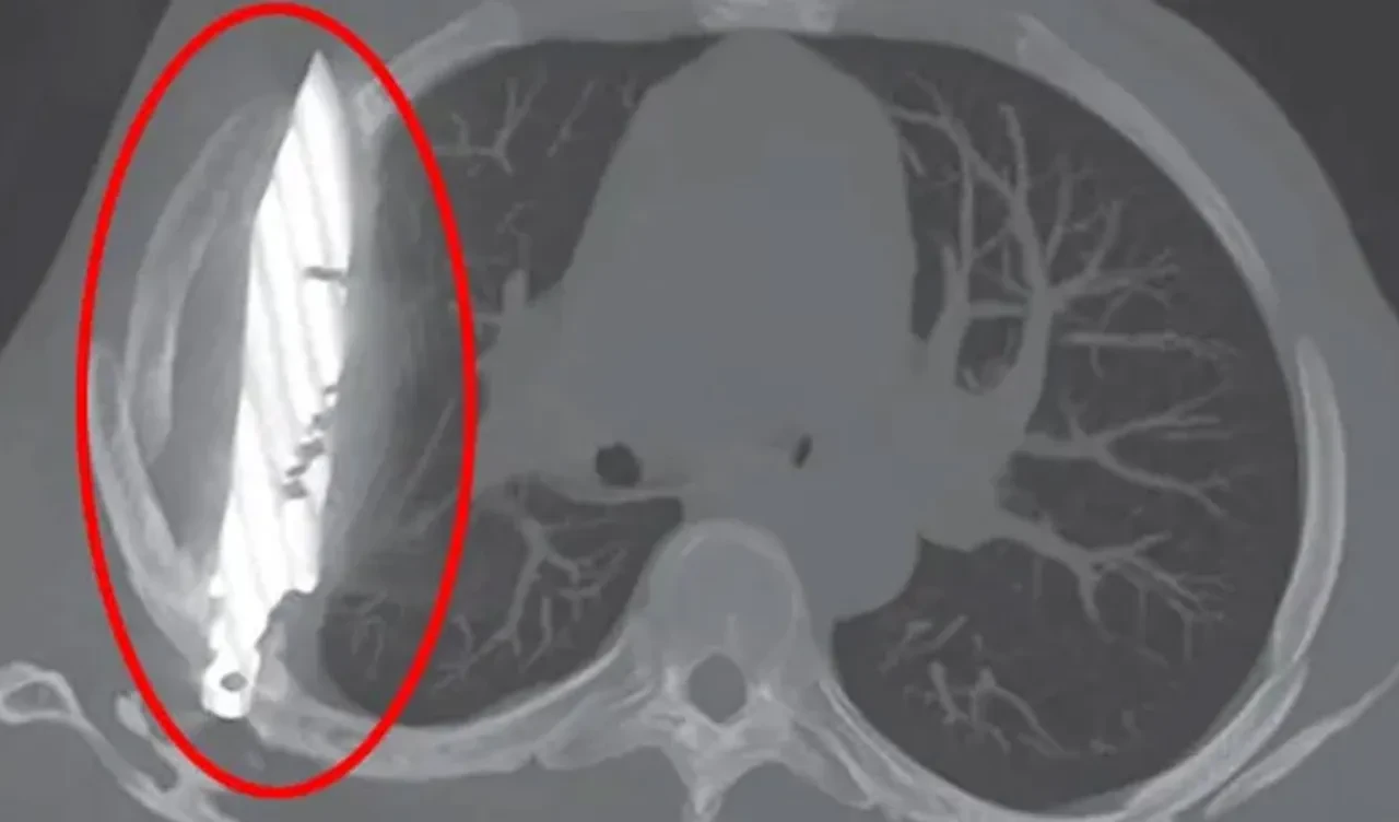 Göğsünde bıçakla 8 sene yaşadı! Seneler önce ettiği kavga aklına geldi