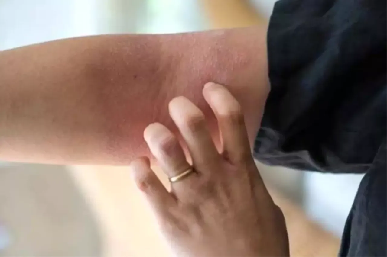 Binlerce lira harcamanıza gerek yok! Bu doğal yöntemlerle egzama kaşıntılarınızı sona erdirebilirsiniz