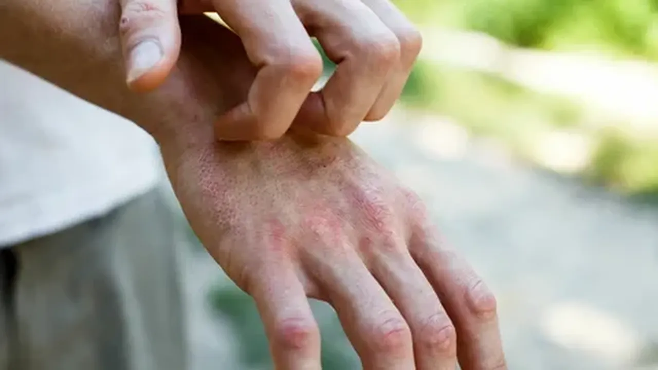 Binlerce lira harcamanıza gerek yok! Bu doğal yöntemlerle egzama kaşıntılarınızı sona erdirebilirsiniz