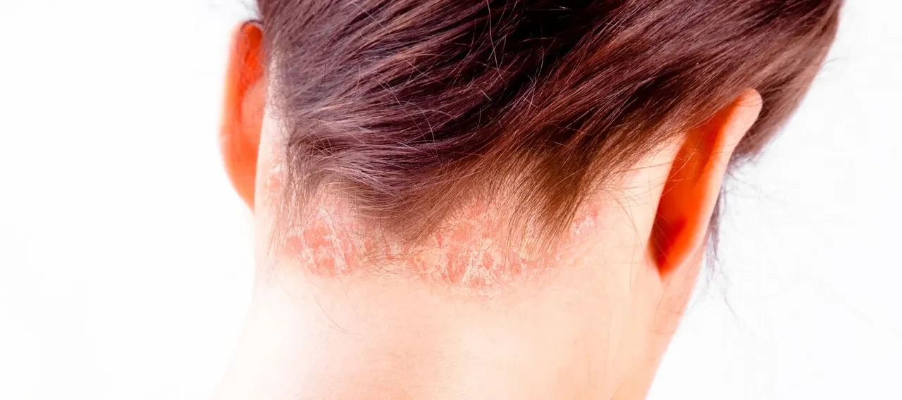 Binlerce lira harcamanıza gerek yok! Bu doğal yöntemlerle egzama kaşıntılarınızı sona erdirebilirsiniz