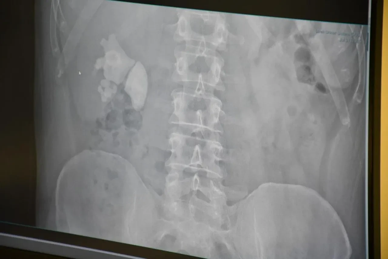 Doktorlar bile şaşkına döndü! Vücudundan tam 100 tane taş çıktı