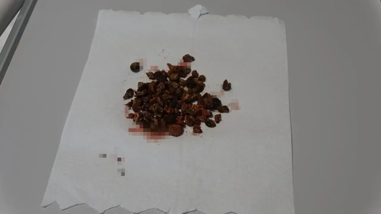 Doktorlar bile şaşkına döndü! Vücudundan tam 100 tane taş çıktı