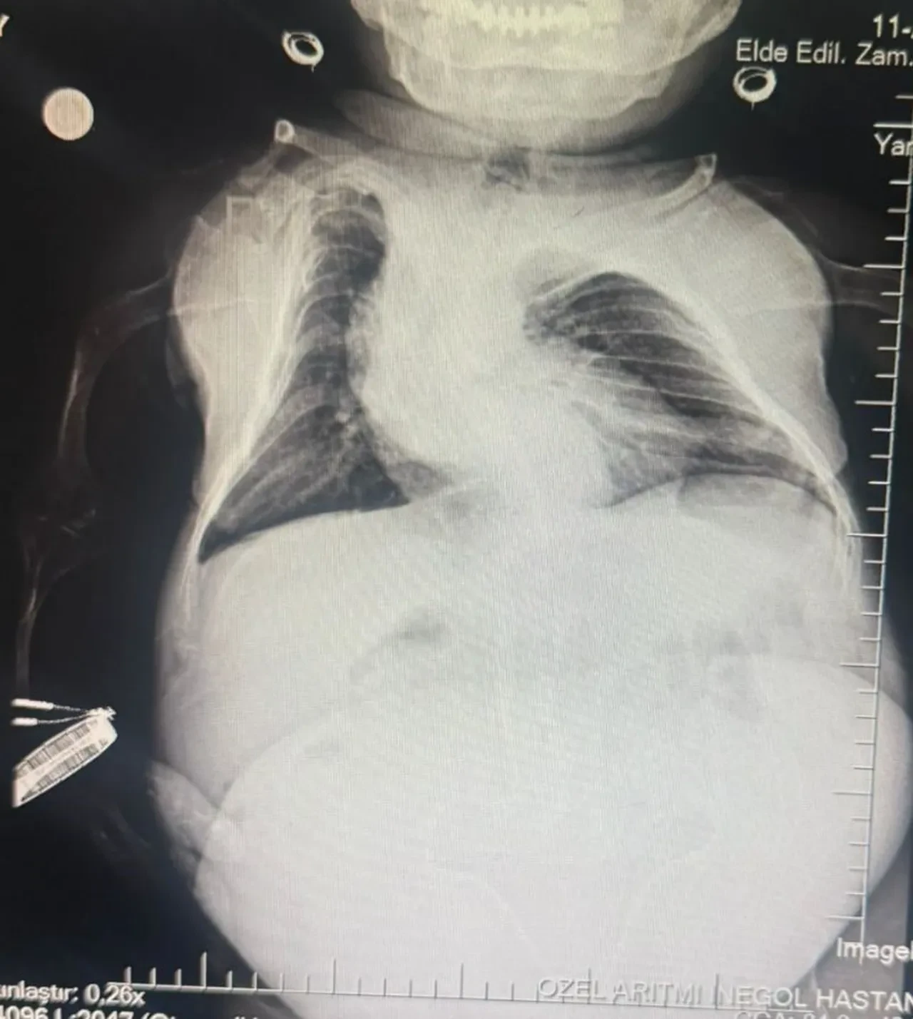Karın ağrısı şikayetiyle gitmişti... 24 kiloluk kadından 3 kilo kist çıktı 