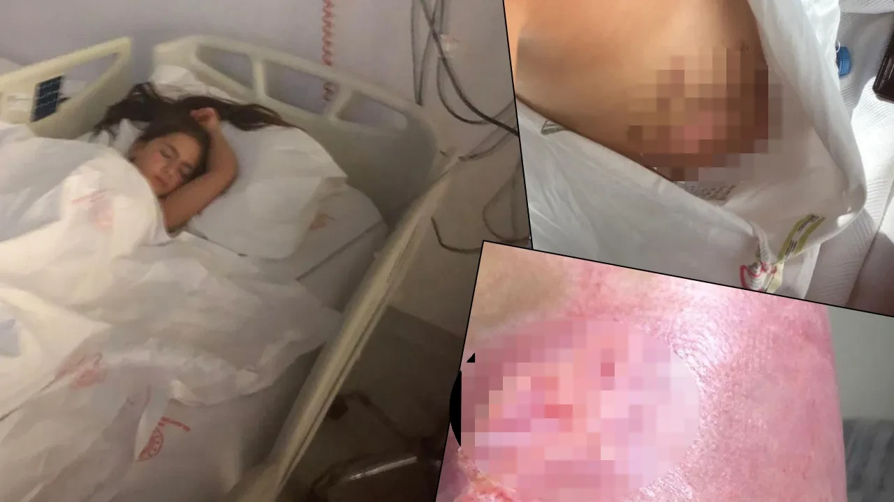Sıvı azot minik Elif'in üzerine döküldü! 19 gün yoğun bakımda kaldı, 7 operasyon geçirdi