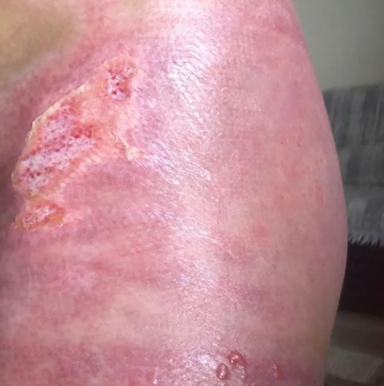 Sıvı azot minik Elif'in üzerine döküldü! 19 gün yoğun bakımda kaldı, 7 operasyon geçirdi