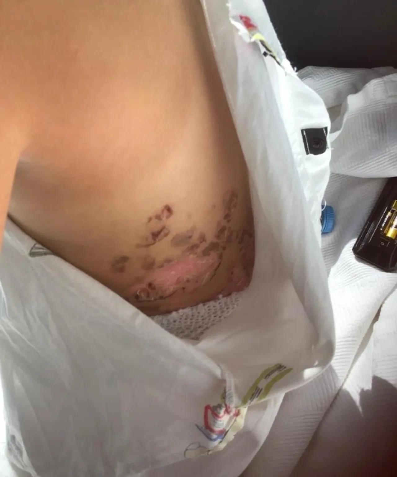 Sıvı azot minik Elif'in üzerine döküldü! 19 gün yoğun bakımda kaldı, 7 operasyon geçirdi