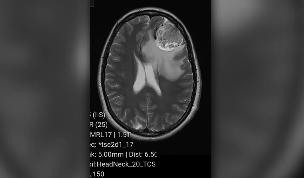 Migren ağrıları ölümcül hastalık çıktı! Üstelik 20 senedir onunla beraberdi