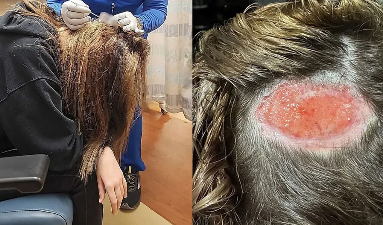 Saçını boyatmak istedi sağlığından oldu: Kafasında çukur açmak zorunda kaldılar