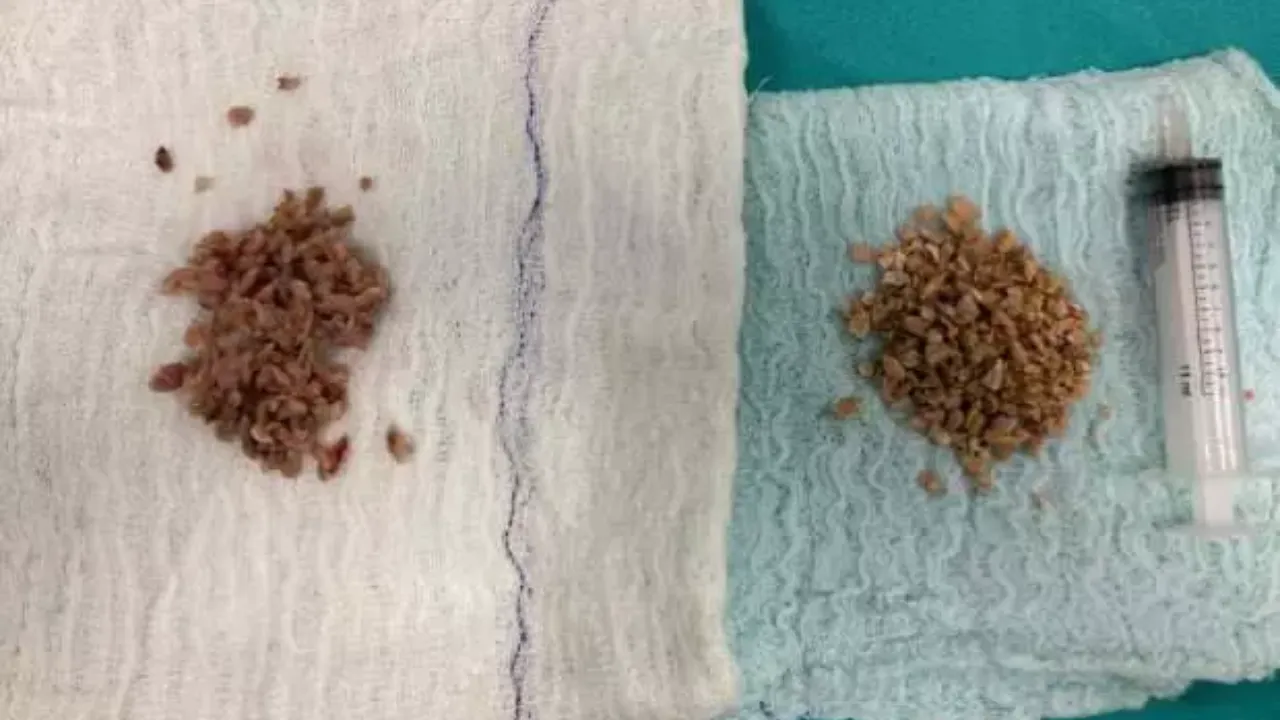 Mesanesinden bir avuç taş çıktı! Doktorlar da şaştı kaldı