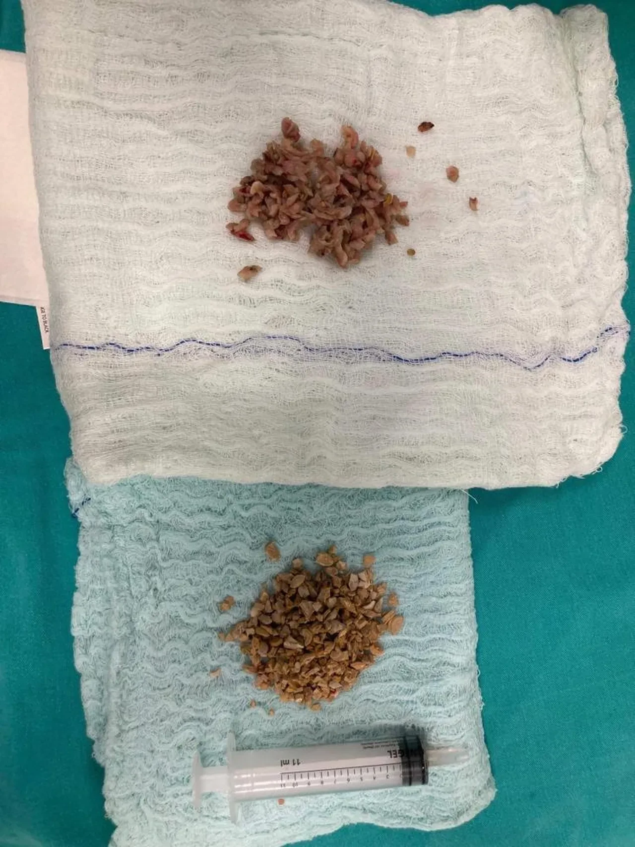 Mesanesinden bir avuç taş çıktı! Doktorlar da şaştı kaldı