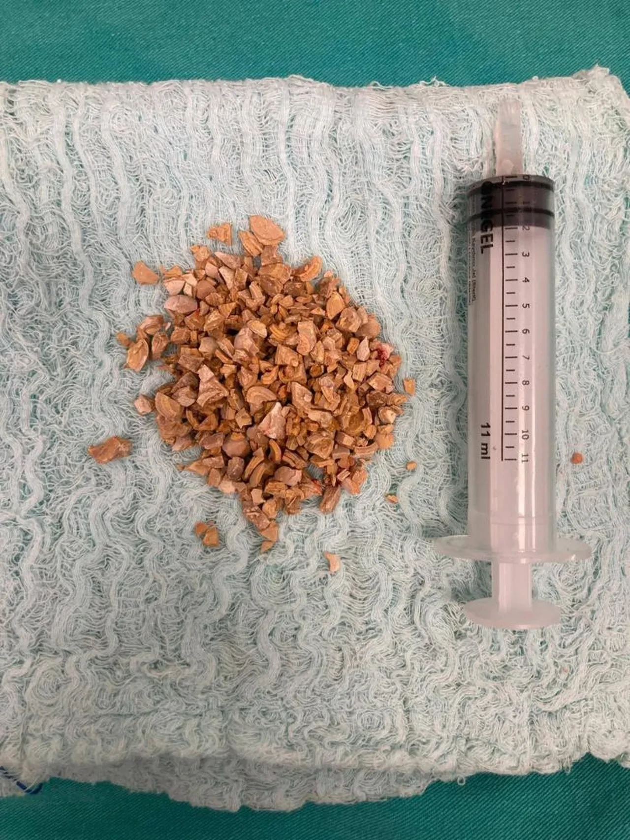 Mesanesinden bir avuç taş çıktı! Doktorlar da şaştı kaldı