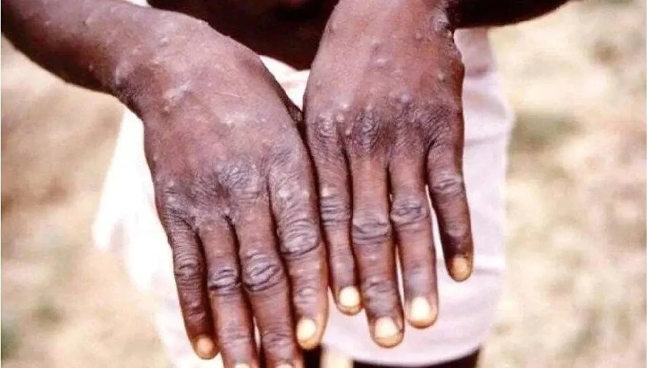 M (mpox) çiçeği virüsü yayılıyor, vakalar artmaya başladı