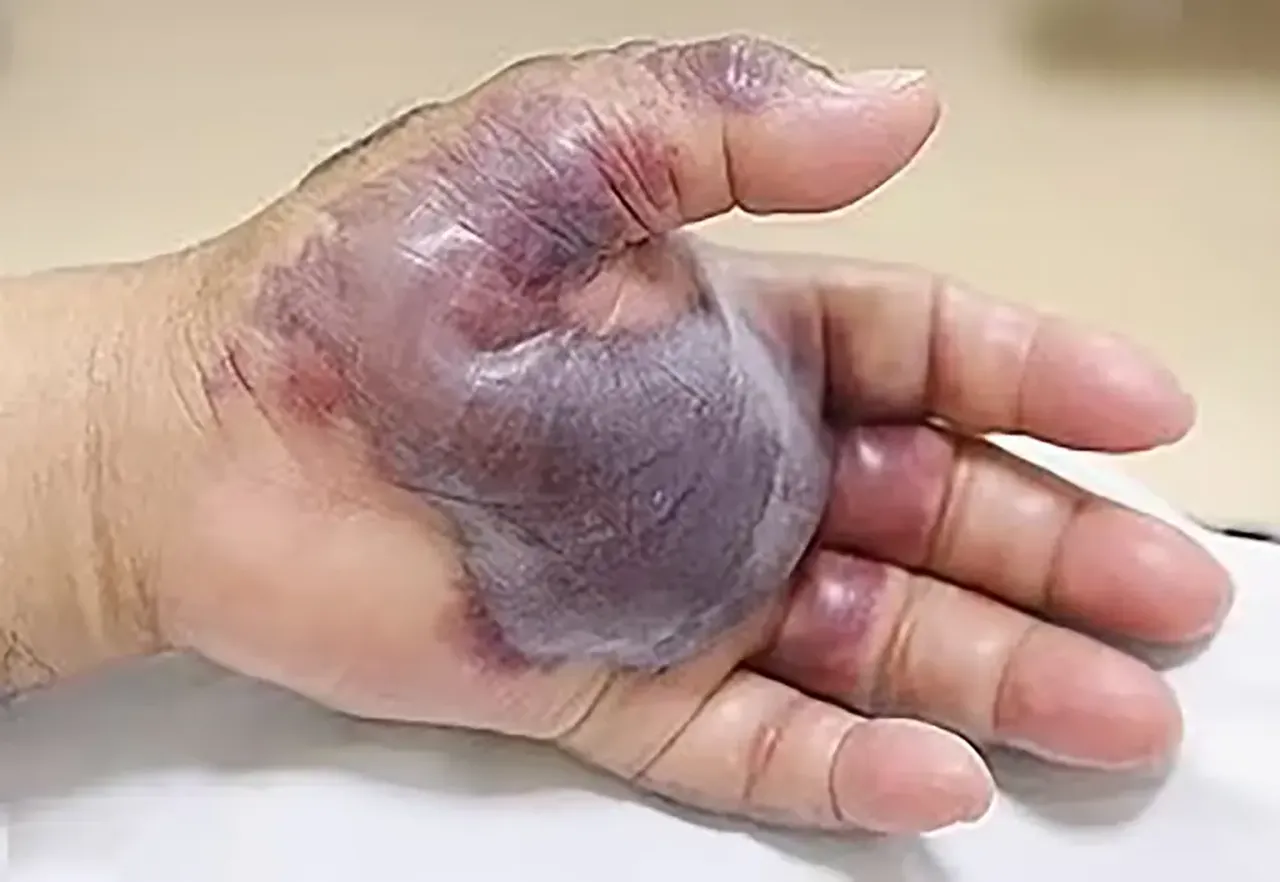 Et yiyen bakteri vakaları tırmandı: Çok sayıda ölü var! Uzmanlar uyarıyor