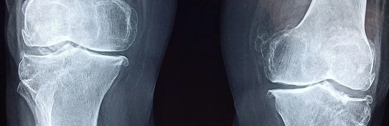 Dizlerinizde 'çıt' sesi mi var? Bunun anlamı ne ve ne zaman doktora görünmelisiniz? İşte sebebi