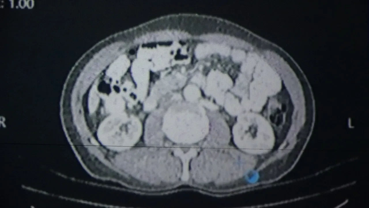 Van'daki doktorlar kanser tedavisinde yapay zekâ kullandı