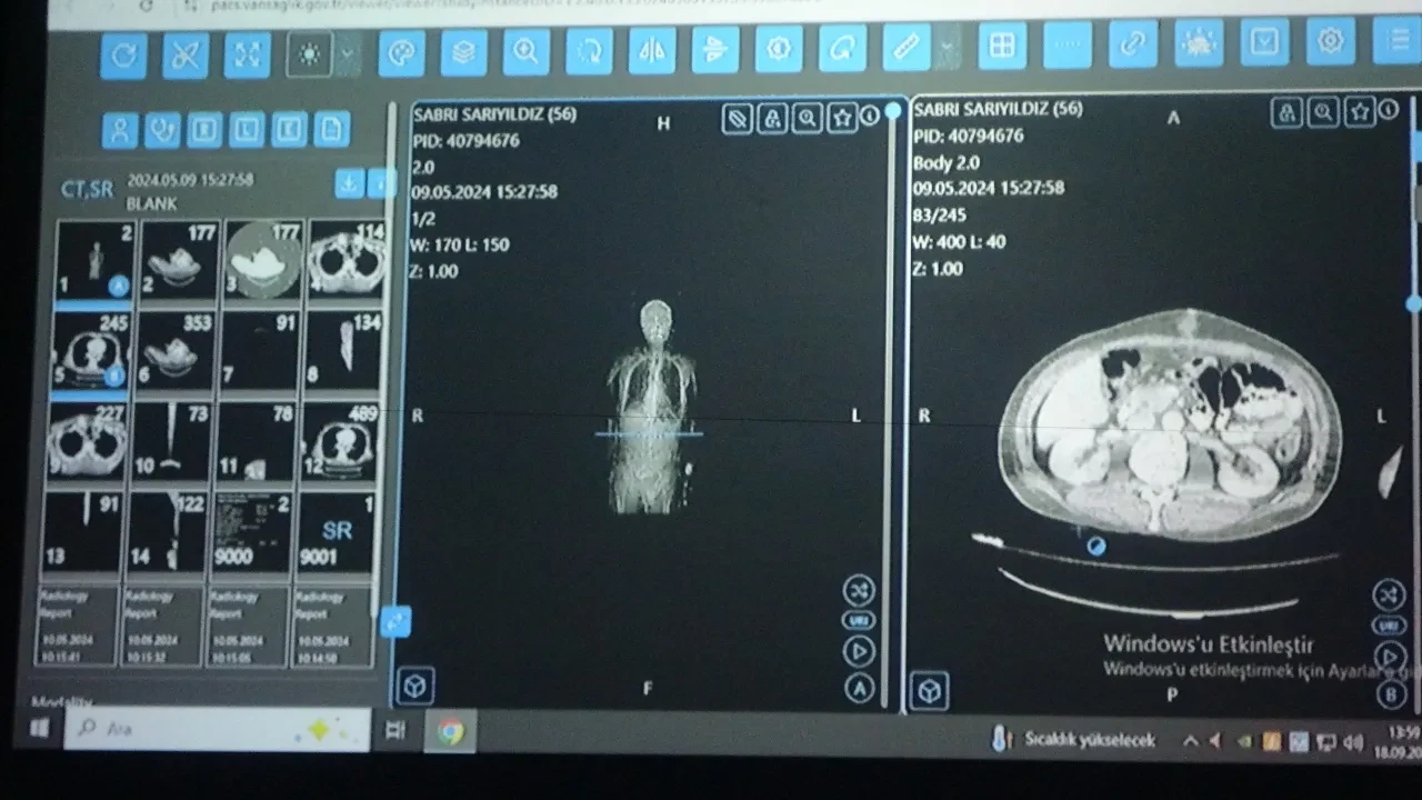 Van'daki doktorlar kanser tedavisinde yapay zekâ kullandı