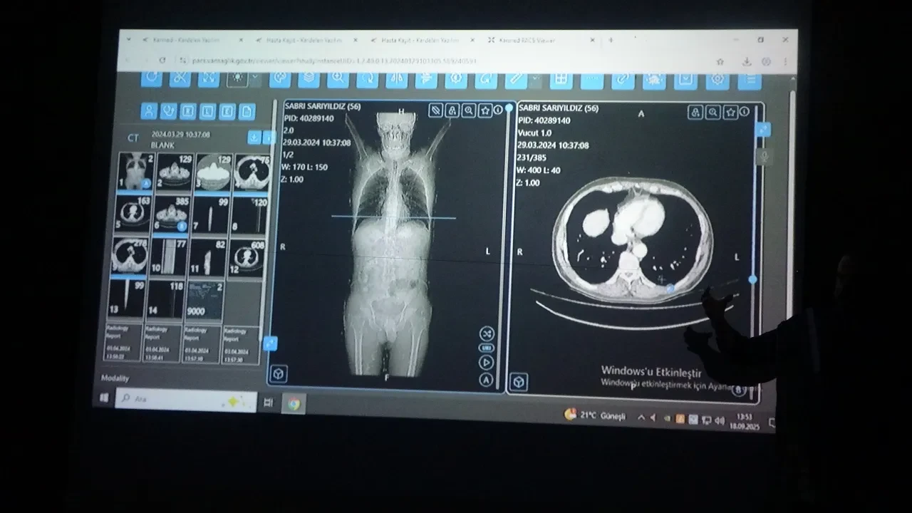 Van'daki doktorlar kanser tedavisinde yapay zekâ kullandı
