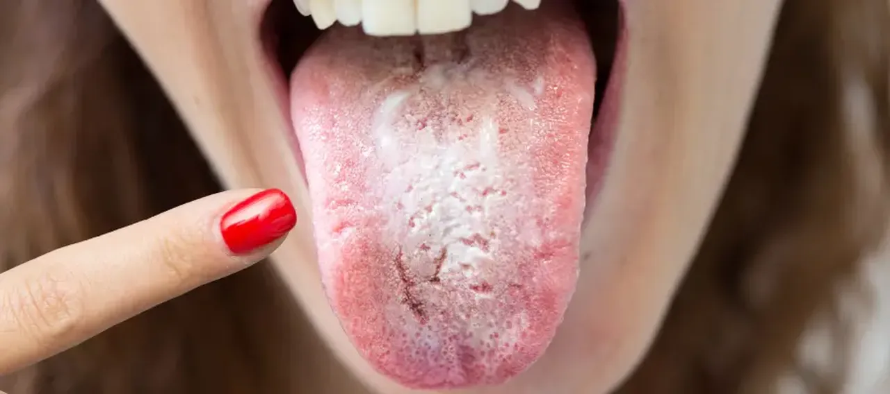 Avrupa'da yüzde 60 artıyor, Yunanistan'da kırmızı alarm verildi! Candida auris mantarı paniği