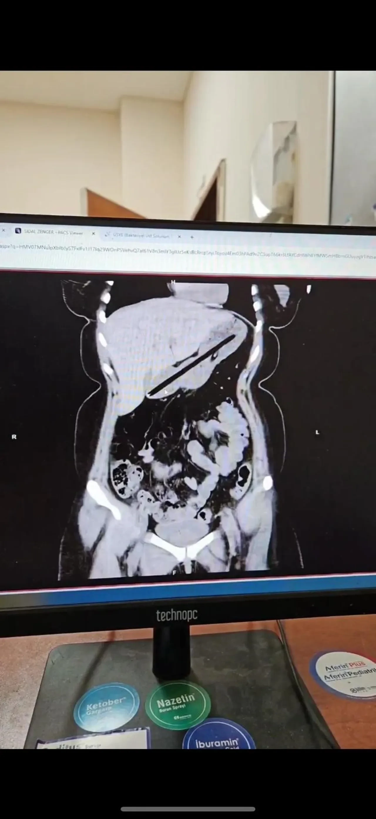Genç kadının midesinden çıkanlar şoke etti: Bu cisimleri ilk kez gördük