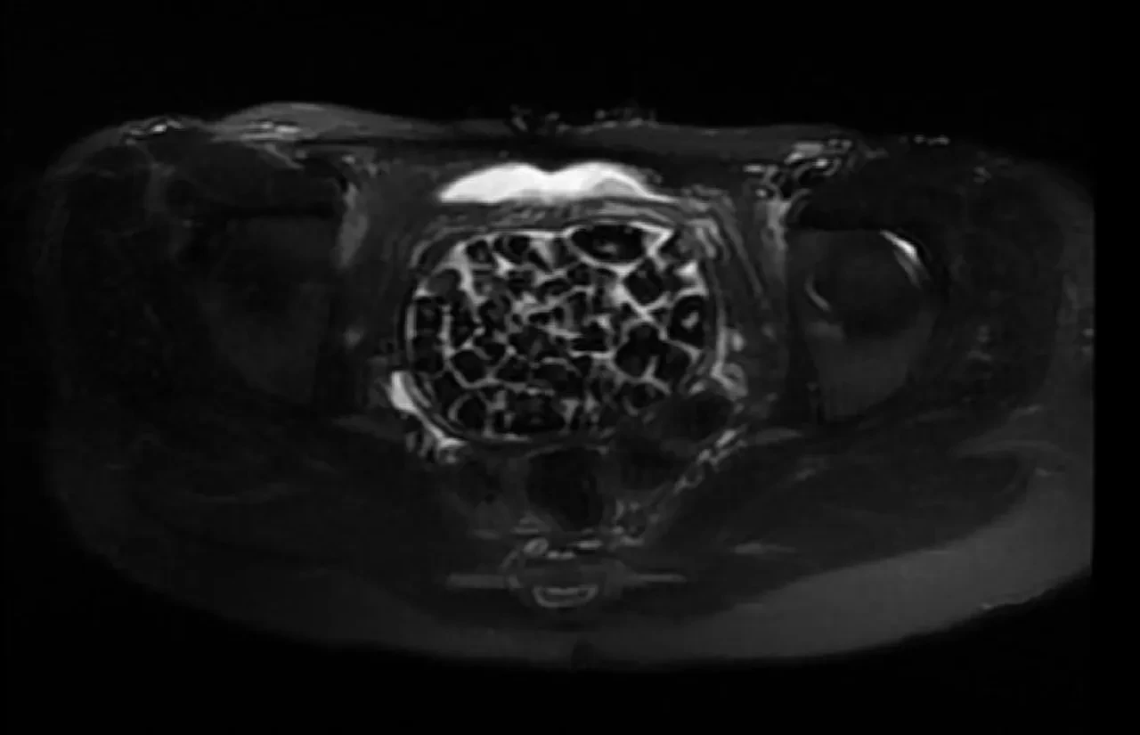 Doktorlar bile şok oldu! Karın ağrısıyla gitti, 287 tane taş çıkarıldı