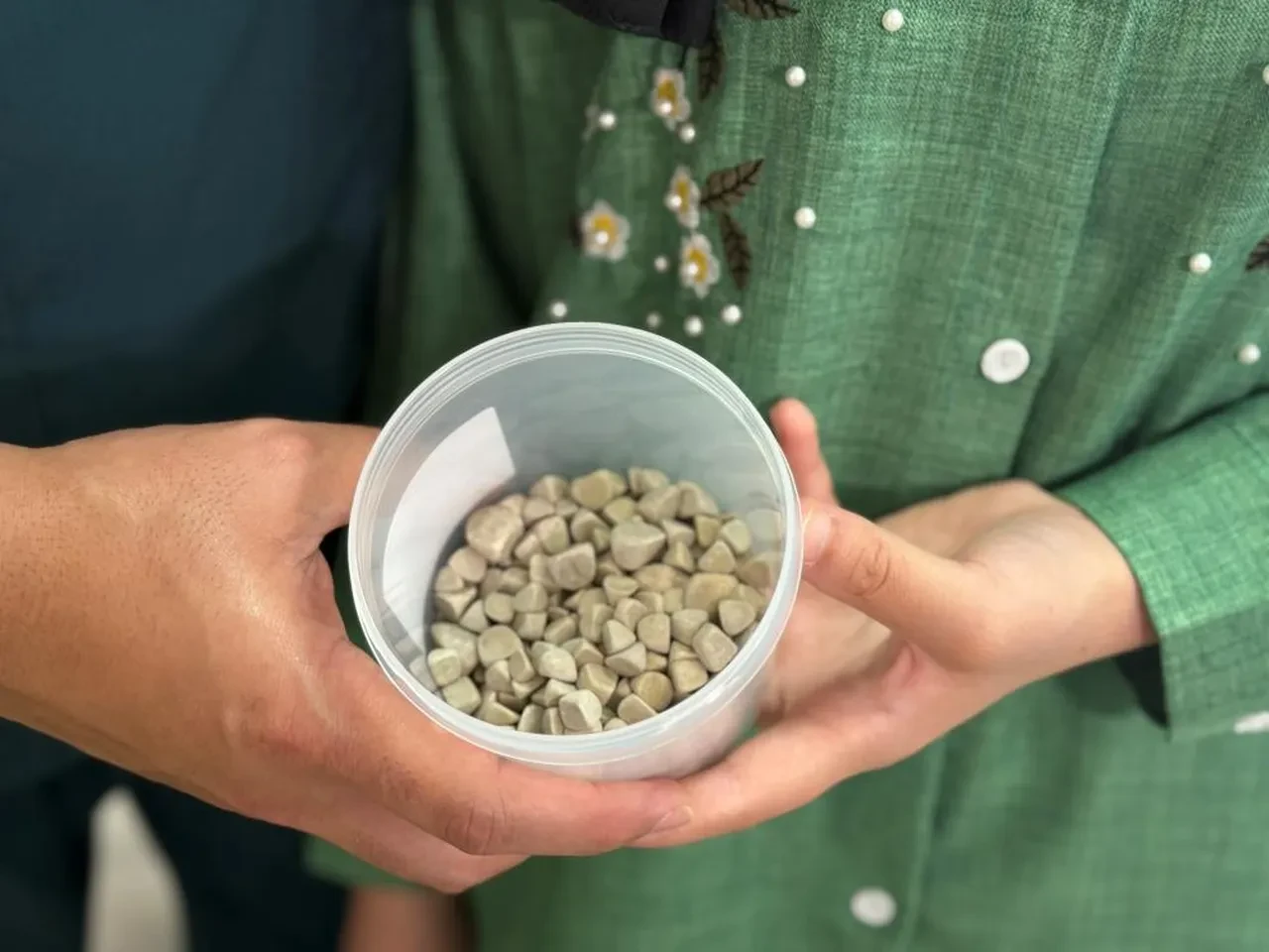 Doktorlar bile şok oldu! Karın ağrısıyla gitti, 287 tane taş çıkarıldı