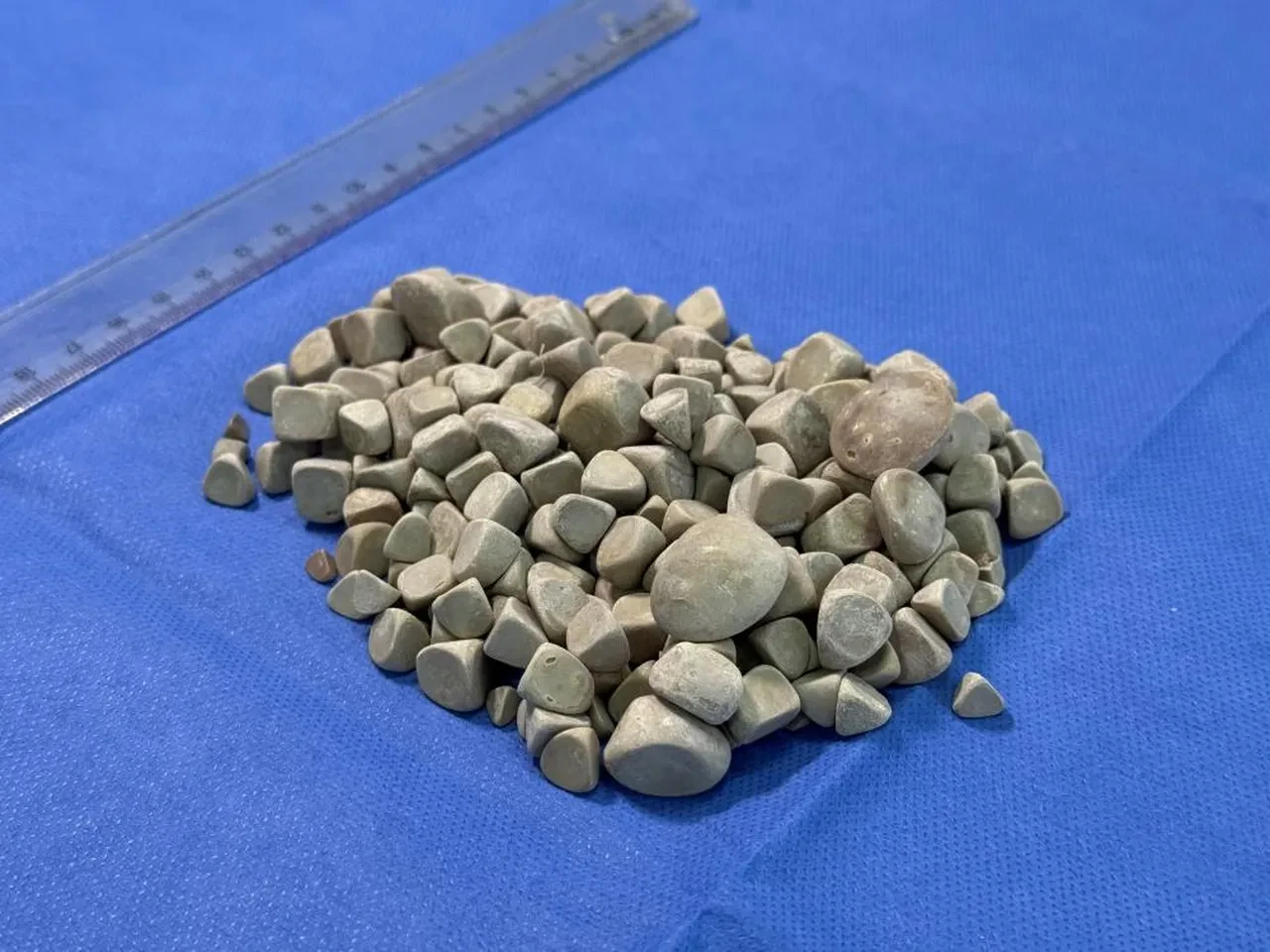 Doktorlar bile şok oldu! Karın ağrısıyla gitti, 287 tane taş çıkarıldı