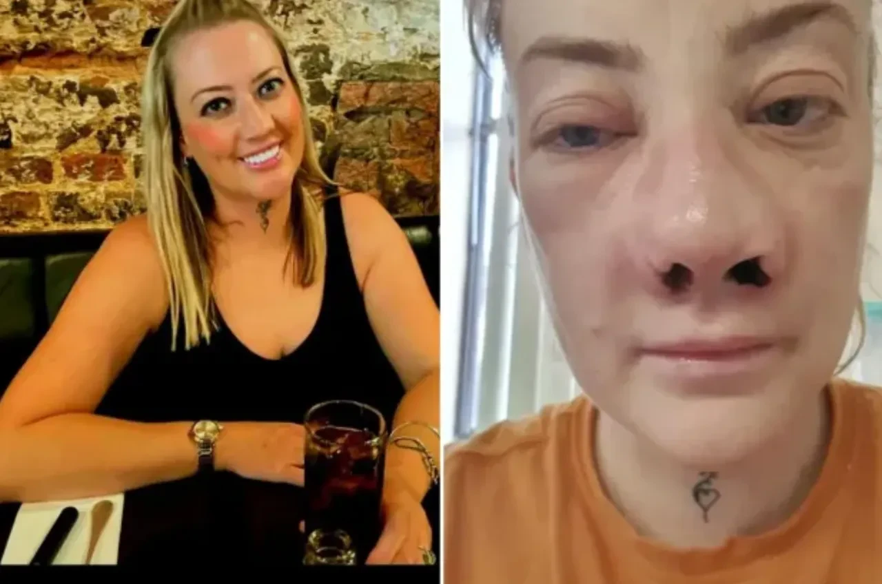 İngiliz kadın Türkiye'de kabusu yaşadı! Yanlış tedavi yüzünden burnu çöktü