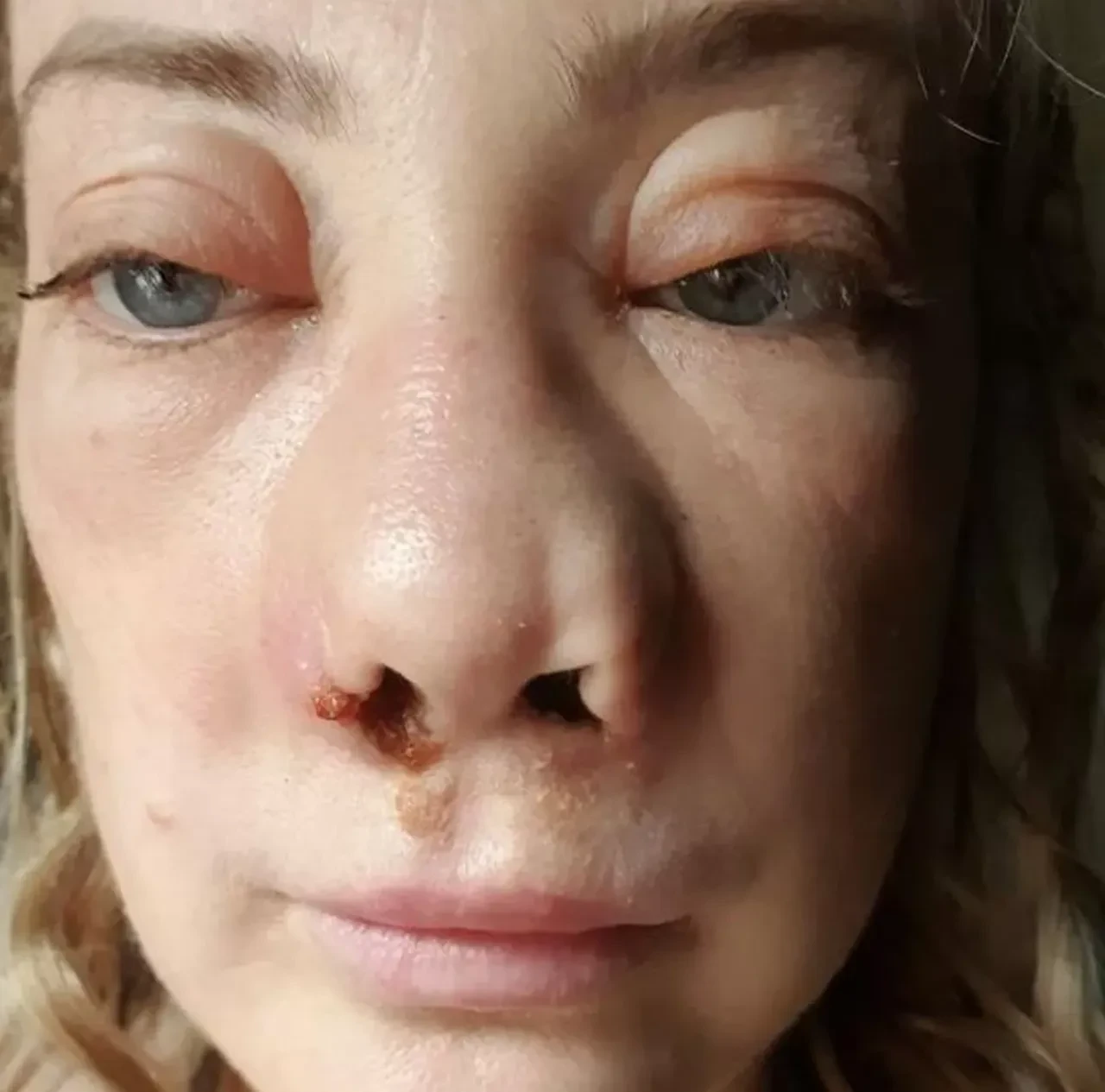 İngiliz kadın Türkiye'de kabusu yaşadı! Yanlış tedavi yüzünden burnu çöktü