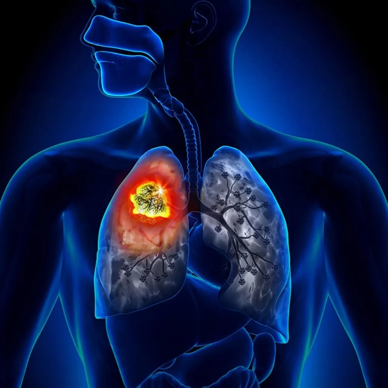 Kanser haritasında endişelendiren veriler! Cinsiyete göre türü değişiyor