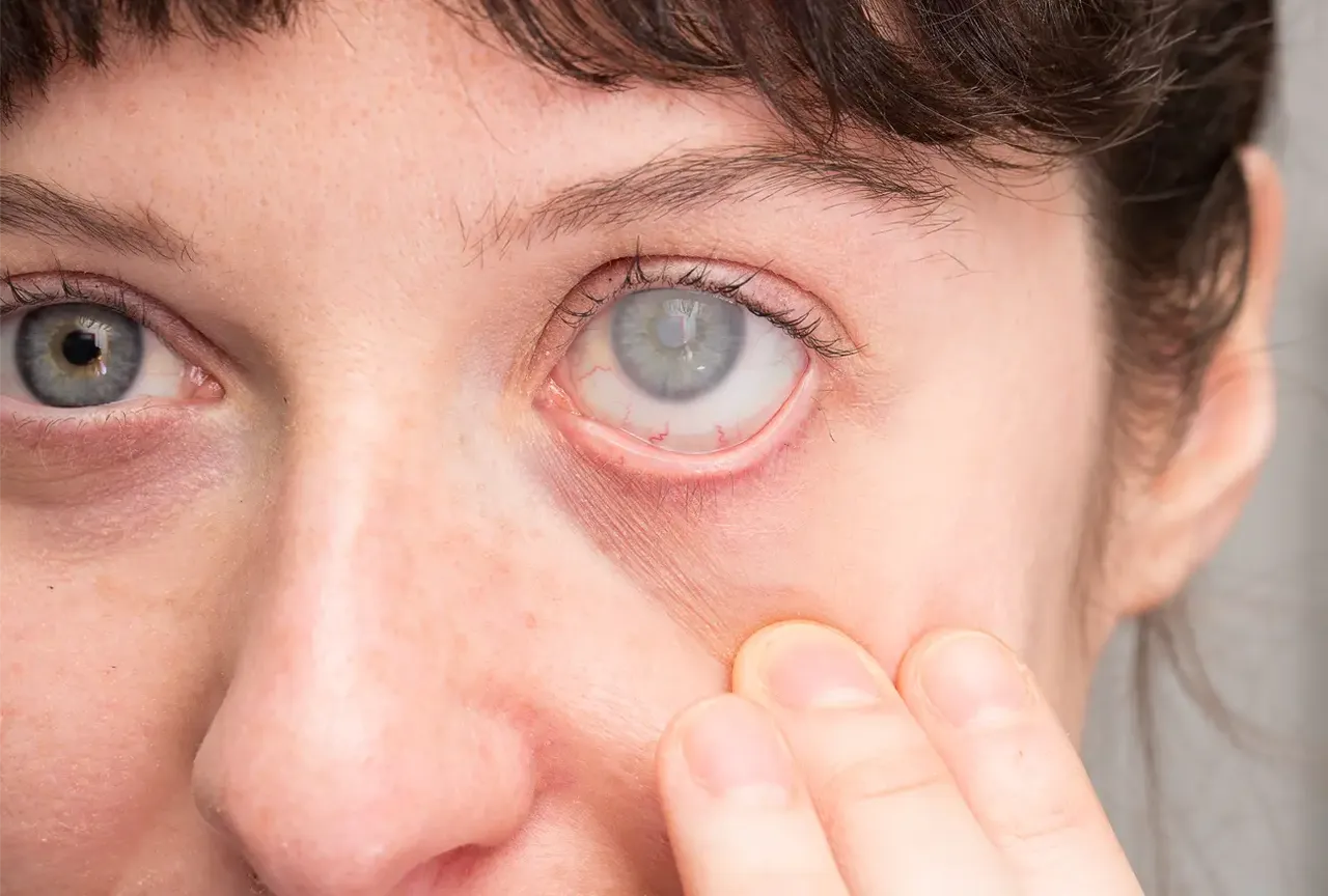 Geri dönüşü olmayan körlük arttı! 2040 yılına kadar 111 milyondan fazla kişiyi etkileyebilir