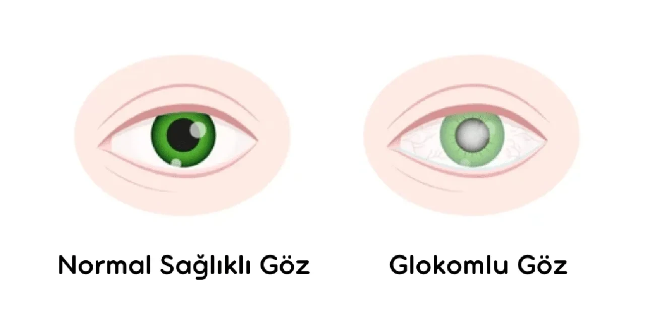 Geri dönüşü olmayan körlük arttı! 2040 yılına kadar 111 milyondan fazla kişiyi etkileyebilir