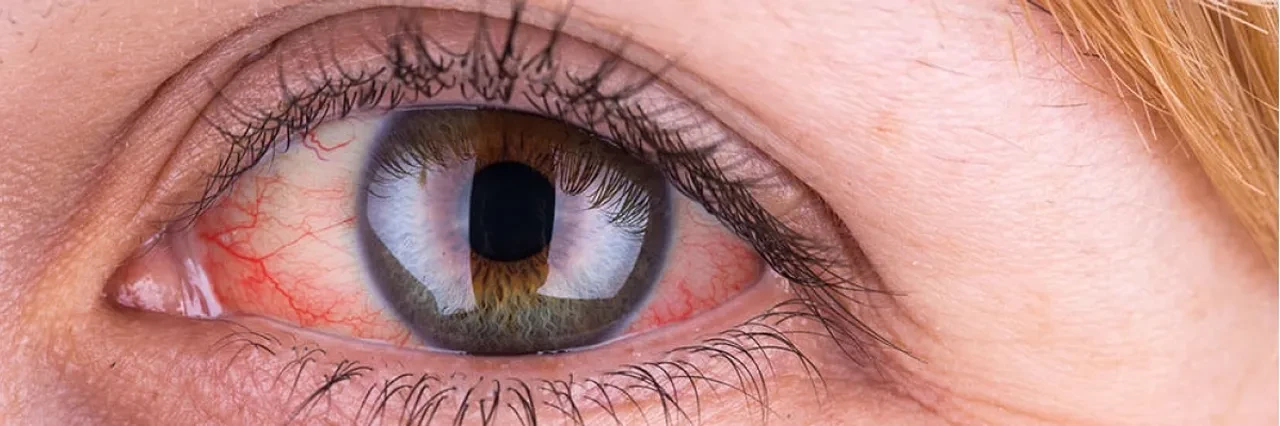 Geri dönüşü olmayan körlük arttı! 2040 yılına kadar 111 milyondan fazla kişiyi etkileyebilir