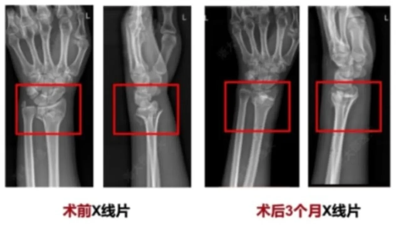 Çinli bilim insanlarından üç dakikada kırık onaran "kemik yapıştırıcısı"