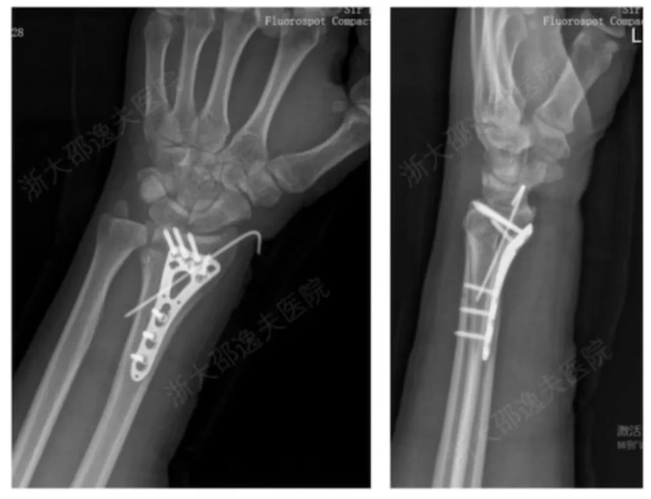 Çinli bilim insanlarından üç dakikada kırık onaran "kemik yapıştırıcısı"