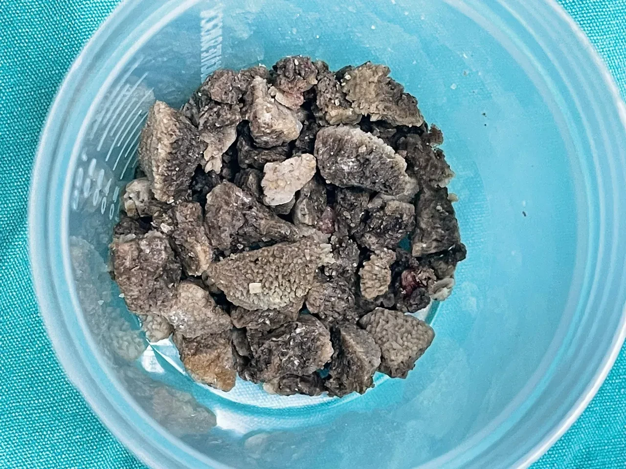 Sağ yan ağrısıyla doktora koştu: 58 yaşındaki kadının röntgeninde 'geyik boynuzu' çıktı