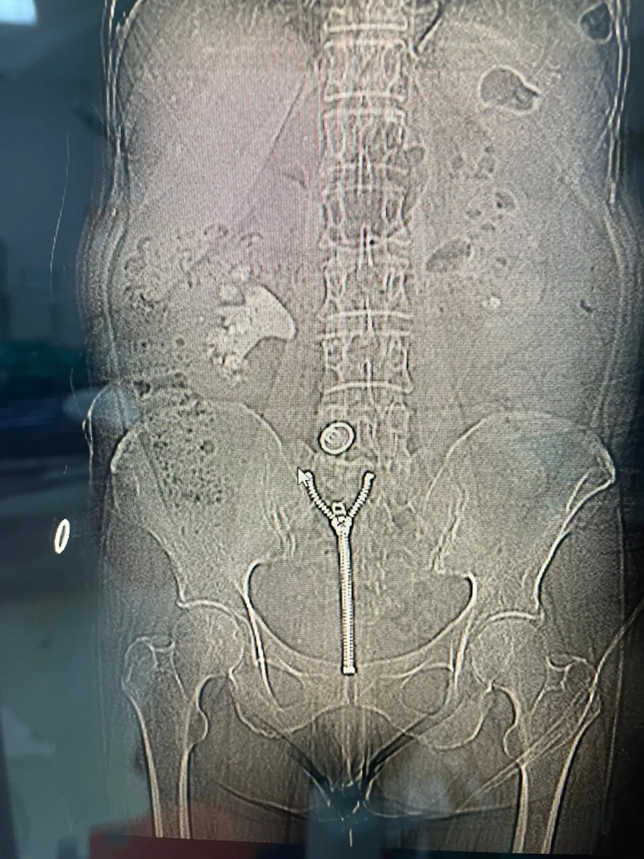 Sağ yan ağrısıyla doktora koştu: 58 yaşındaki kadının röntgeninde 'geyik boynuzu' çıktı