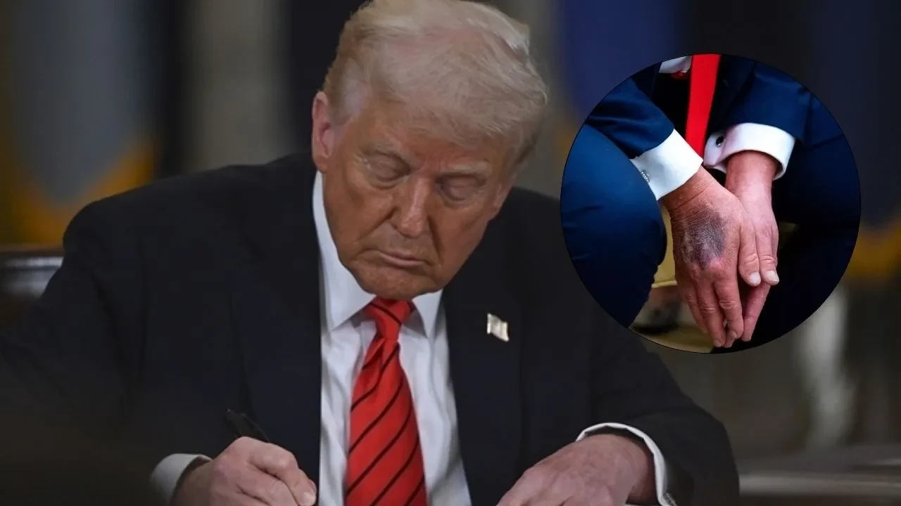 Trump ellerindeki morluğun sebebini açıkladı: Tam 25 yıldır kullanıyor! Doktorların önerdiğinden bile fazla