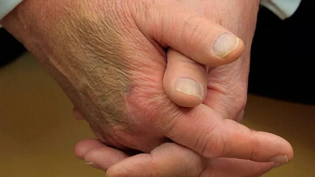 Trump ellerindeki morluğun sebebini açıkladı: Tam 25 yıldır kullanıyor! Doktorların önerdiğinden bile fazla