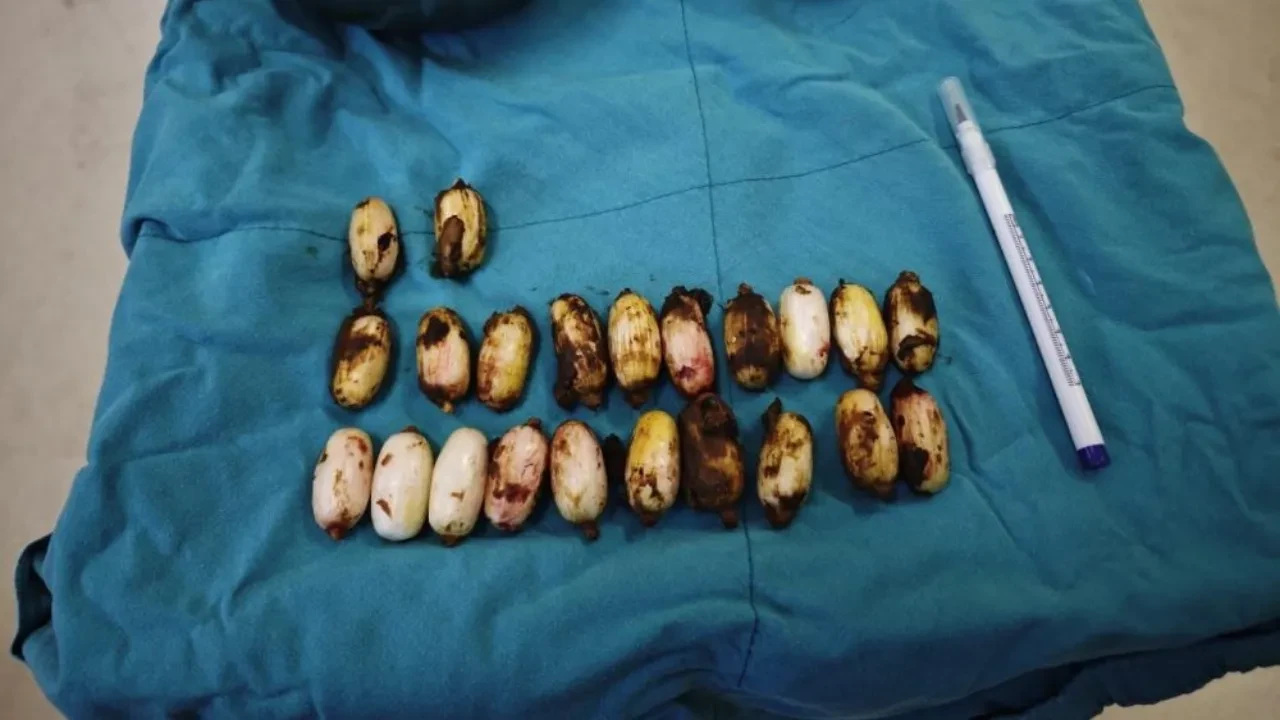 Midesinden çıkanlar şoke etti! Tam 44 tane...