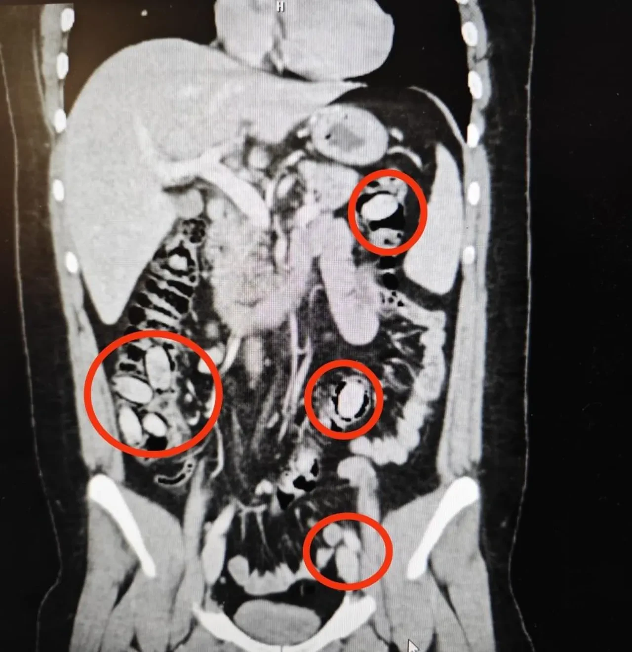Midesinden çıkanlar şoke etti! Tam 44 tane...