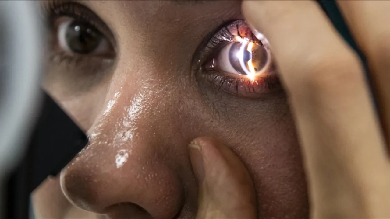 Kırmızı gözün arkasındaki tehlike! Kirpik dibi paraziti