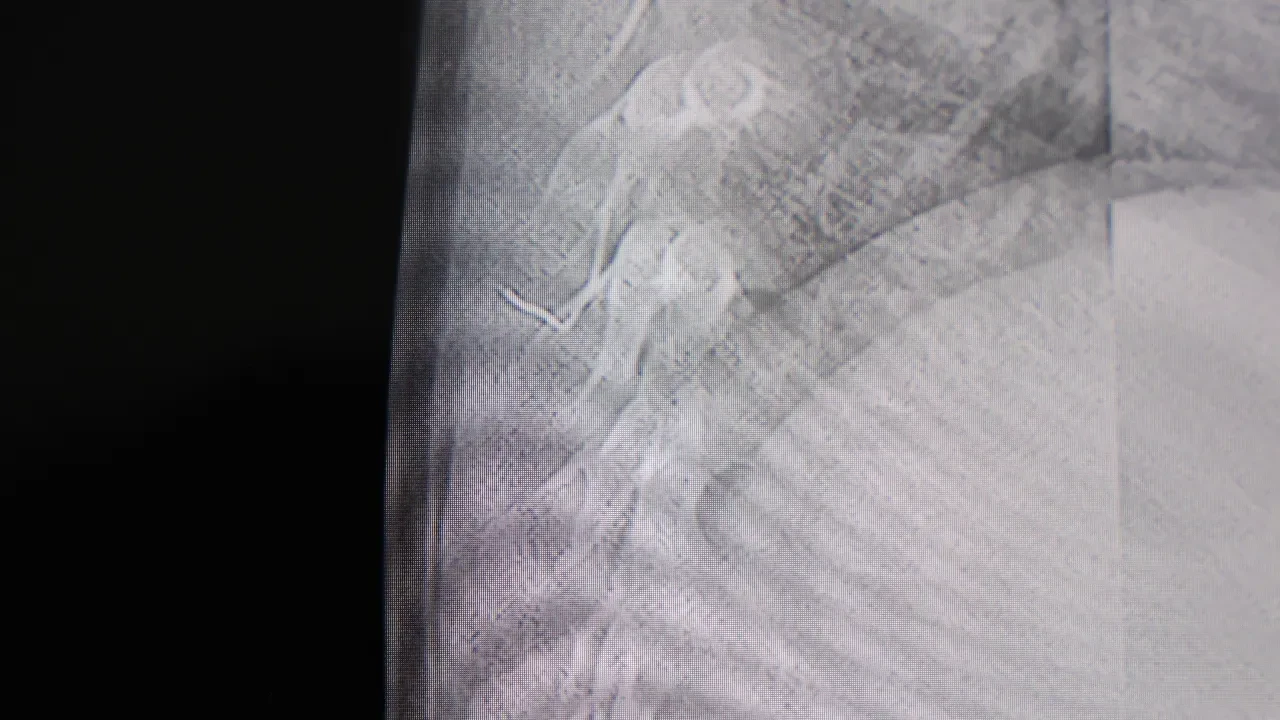 Bebeğin sırtından çıkan cisim şok etti! Gerçek hastanede ortaya çıktı